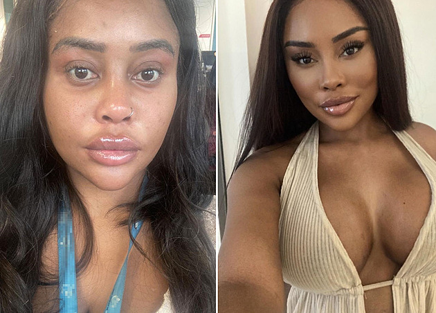 Facelift i plastika prsou před třicítkou. Modelka chtěla být dokonalá